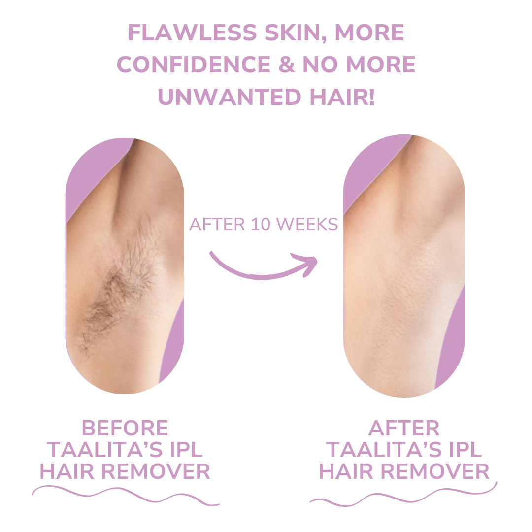 Mini Laser Hair Remover