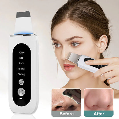 Black Dots Blackhead Remover Facial Peeling Machine
